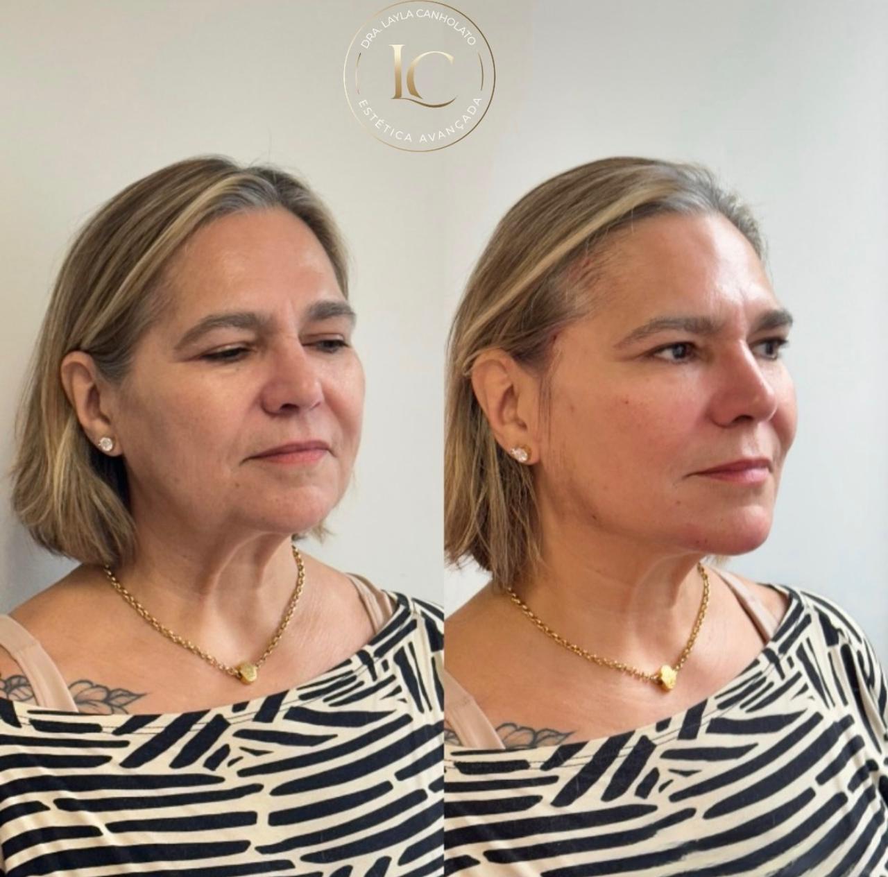 Antes e depois Método Time Reverse 2