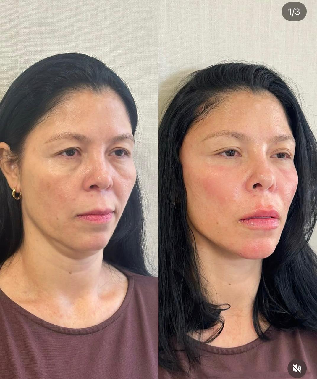 Antes e depois Método Time Reverse 6